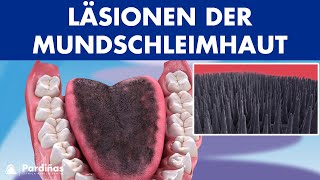 Landkartenzunge Lichen ruber planus Leukoplakien und andere Mundschleimhautentzündungen © [upl. by Nniw]