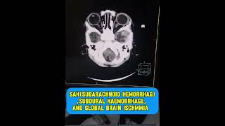 Subarachnoid hemorrhage  subdural hemorrhage  global brain ischemia  CT scan brain pediatrics [upl. by Torray]