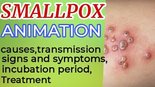 Smallpox symptoms  smallpox treatment  small pox  smallpox animation  smallpox virus  3D [upl. by Yatnuhs]