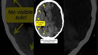 Subacute Ischemic Stroke on Imaging radiology medicalstudent [upl. by Yseult86]