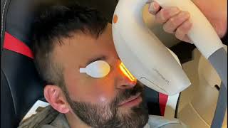 Dry eye treatment Intense PulsedLight IPL Therapy [upl. by Angelina]