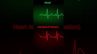 ECG Normal vs Heart Attack ST Elevation How to Read ECG in Simple Steps HeartHealth ECGInterpret [upl. by Ellednahs284]