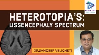 HeterotopiasLissencephaly SpectrumSandeep velichetiLissencephaly spectrum type 1 part2ped neuro [upl. by Wrightson]