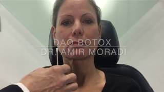 Botox in Depressor Anguli Oris DAO Muscle Dr Amir Moradi San Diego California [upl. by Viccora]