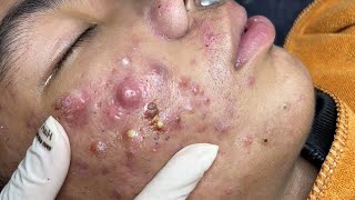 Big Cystic Acne Blackheads Extraction Blackheads amp Milia Whiteheads Removal Pimple Popping  4660 [upl. by Drapehs]