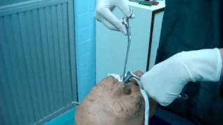 Nasal Packing Removal from The Nose Medical Videos [upl. by Winthrop368]