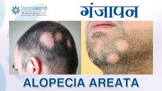 बाल झड़ना  गंजापन  Alopecia Areata Balding in patches  How to stop them Dr Rohit Batra [upl. by Aicilram]