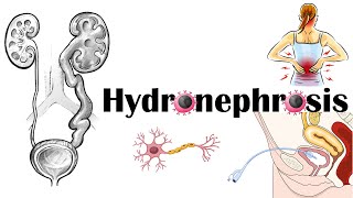 Hydronephrosis  Definition Functional Anatomy Causes Signs amp Symptoms Diagnosis amp Treatment [upl. by Linell449]