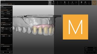 Creating crowns on thimble substructures in ZirkonzahnModellier  ZirkonzahnSoftware [upl. by Jegger449]