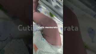 Cutis marmoratanewborn paeds clinical [upl. by Yrrem]