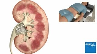 How extracorporeal shockwave lithotripsy is used to treat kidney stones  Bupa Health [upl. by Aldora]