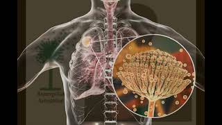 MICOSIS BRONCOPULMONAR ALÉRGICA O ASPERGILOSIS CAUSAS SÍNTOMAS Y TRATAMIENTO [upl. by Lorien294]