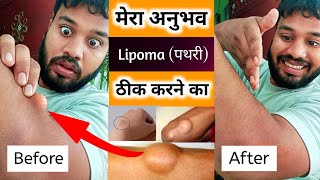 Lipoma Natural Treatment  Lipoma Exercise Treatment  Lipoma Ko Kaise Theek Karen  Lipoma Gath [upl. by Sidran]