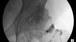 Hip Injection under Fluoroscopic Guidance  ThePainSourcecom [upl. by Ylatfen]