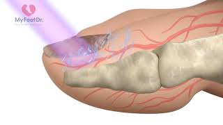 Lunula Laser Treatment For Fungal Toenails [upl. by Moorefield]