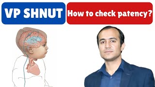 VP Shunt Patency Check StepbyStep Guide for Healthcare Professionals [upl. by Nyrraf]