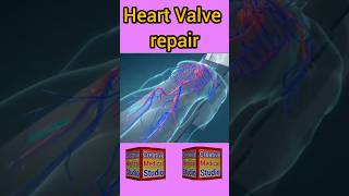 Heart Valve repair  Heart valve procedure  heart surgery [upl. by Llerraf]