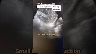 How small bowel obstruction is diagnosed on ultrasoundultrasound abdomen [upl. by Steady493]