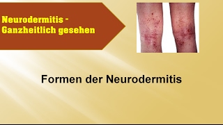 Formen der Neurodermitis  GANZMEDIZIN Naturheilpraxis [upl. by Yeleen]