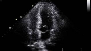 excess mitral tissue moving into the LVOT without subaortic obstruction [upl. by Arihay]