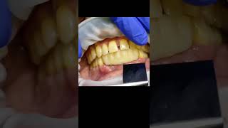 6 unit lower anterior PMMA implant bridge trial before gum addition  for occlusal clearance [upl. by Einhoj]