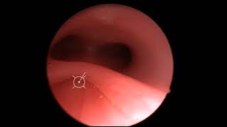 Laryngotracheal Cleft [upl. by Dibrin]