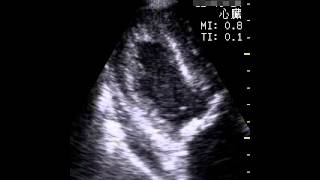 図２心室細動のエコー画像 [upl. by Oluap606]