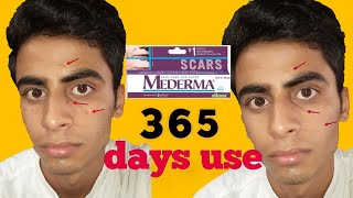 mederma cream honest review 😥 how to remove old and new scar [upl. by Salhcin512]