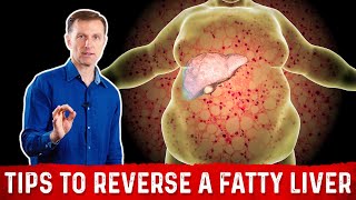 4 Critical Tips to Reverse a Fatty Liver – Dr Berg [upl. by Signe]