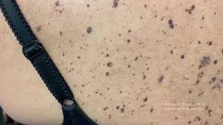 Removal of pigmented seborrheic keratosis [upl. by Grissom]