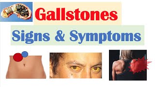 Gallstones Signs amp Symptoms Why They Occur  Cholecystitis Choledocholithiasis Cholangitis [upl. by Arbua249]