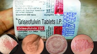 Griseofulvin 250 mg tablets uses in hindi  Griseofulvin tablet  griseofulvin 250 mg tablet uses [upl. by Abibah313]