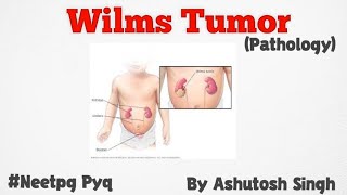 Wilms Tumor For 2nd year University Exams [upl. by Allisurd]