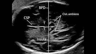 How to measure Biparietal diameter by Ultrasonography [upl. by Ciapha]