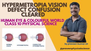 Hypermetropia vision defectCorrection  human eye and colourful world made easy [upl. by Siloam]