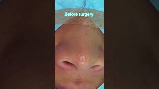 THE PROCESS OF A NOSE JOB  DR TANVEER JANJUA NEW JERSEY [upl. by Atirys]