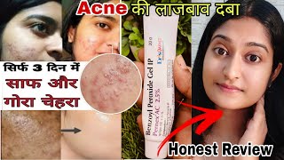 Benzoyl Peroxide Gel Honest Review  Benzoyl peroxide gel 25 Pernex  Benzoyl peroxide for acne [upl. by Cartwell]