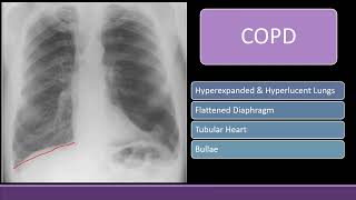 Chest Xray with Black lung field COPD Pneumothorax amp Bullae cxr radiology [upl. by Lennod739]