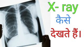 How to read Chest Xray  Hindi language [upl. by Zachariah]