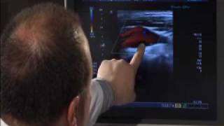 Carotid Artery Ultrasound [upl. by Elburr364]