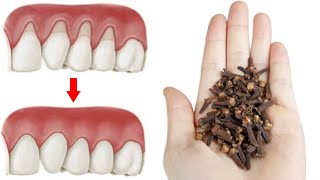 3 Ways to Heal Receding Gums At Home Naturally [upl. by Atnwahs]