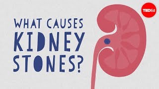 What causes kidney stones  Arash Shadman [upl. by Denny499]