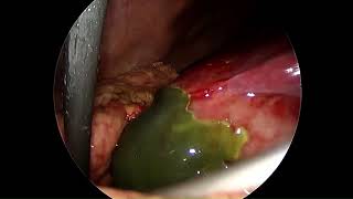 Laparoscopic Cholecystectomy in Gangrenous Gall Bladder [upl. by Nanreit]