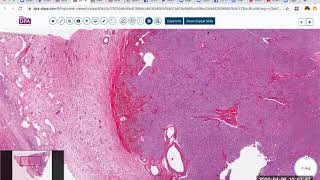 Steroid cell tumor of the ovary [upl. by Anora]