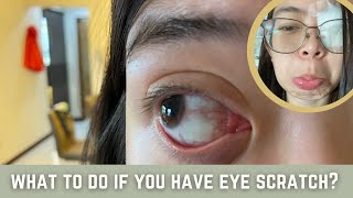 What is corneal abrasion [upl. by Agn394]