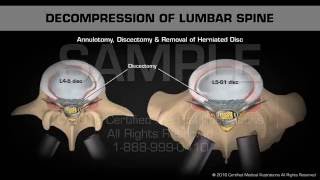 Decompression of Lumbar Spine [upl. by Aihsinyt662]