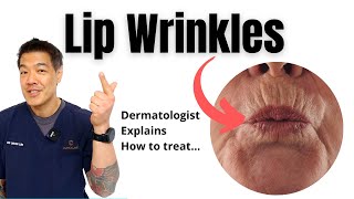 Why Do Women Get Upper Lip lines  Dermatologist explains Causes amp Solutions [upl. by Nnylharas684]