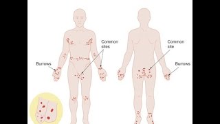 Scabies [upl. by Ursuline]