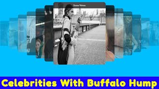 Celebrities With Buffalo Hump [upl. by Carn]