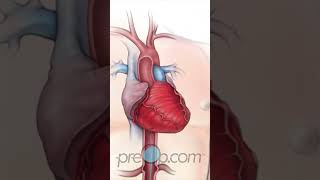 PreOp® 🌟 Cardiac Catheterization A Closer Look preop shorts health 💡 [upl. by Akeret]